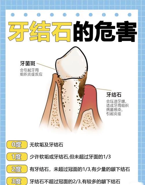 种牙前必须洗牙吗？术前口腔清洁的必要性是什么？-图1