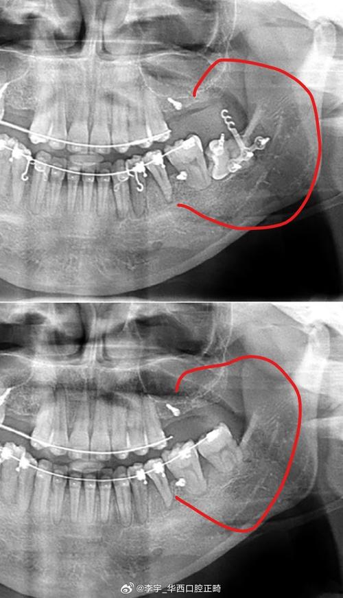 低位水平阻生齿正畸-图1 低位水平阻生齿正畸-图1