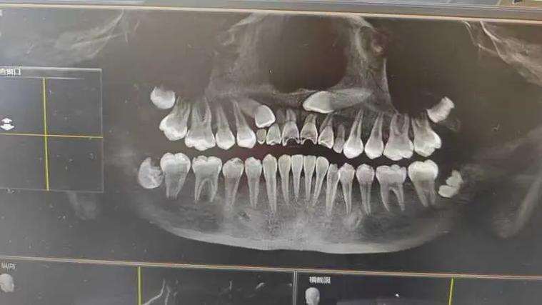 低位水平阻生齿正畸-图3 低位水平阻生齿正畸-图3