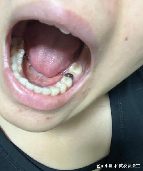 拔牙3年后种牙-图3