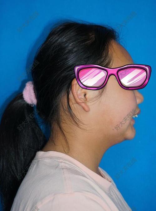 23岁上颌前突正畸-图1