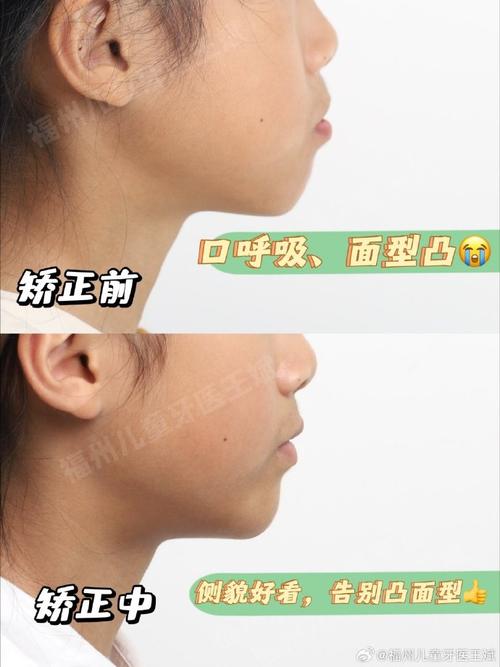 23岁上颌前突正畸-图2