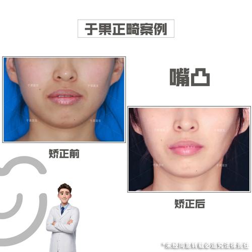 正畸没拔牙嘴会凸吗-图2