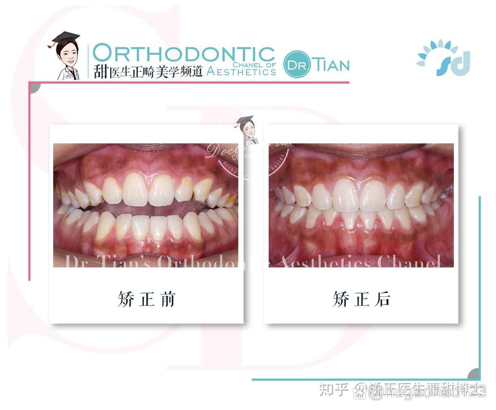 正畸没拔牙嘴会凸吗-图1