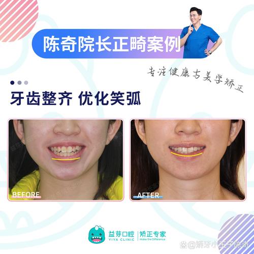 正畸没拔牙嘴会凸吗-图3