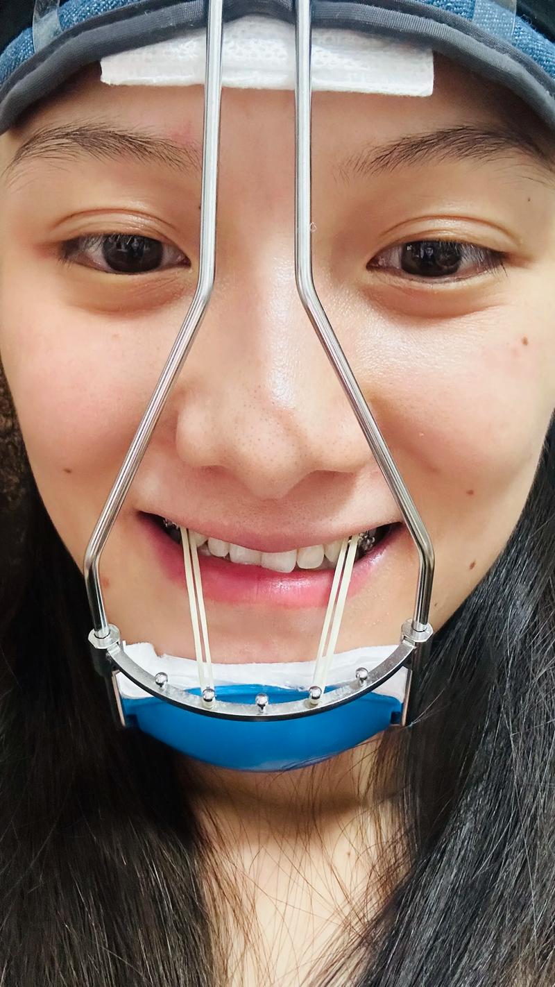 正畸三类牵引地包天-图1