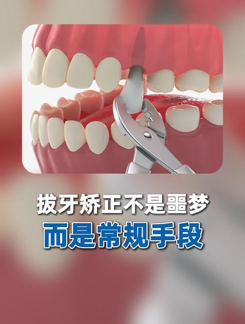 拔第一磨牙进行正畸-图1