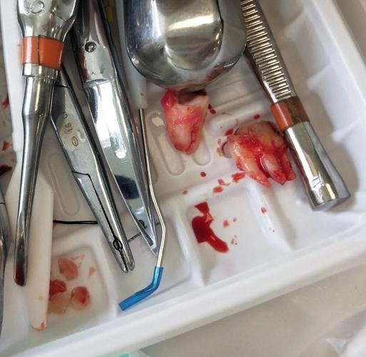 拔第一磨牙进行正畸-图3