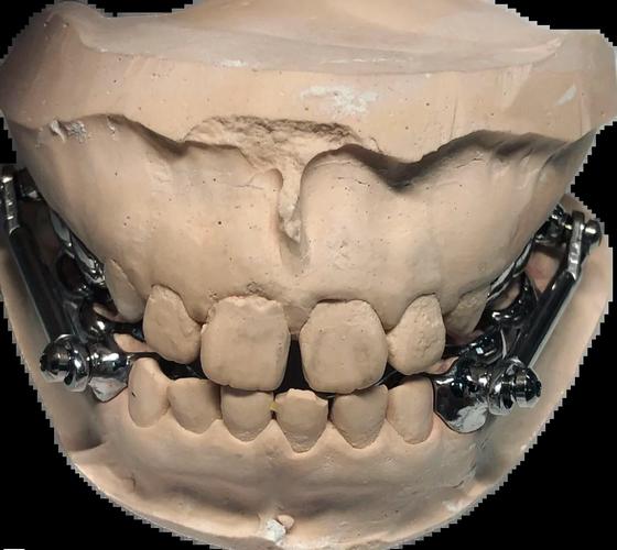 正畸的拉簧在尖牙上-图1