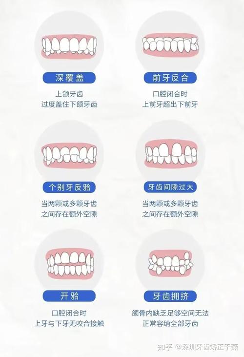 正畸牙龈需要多少钱-图3