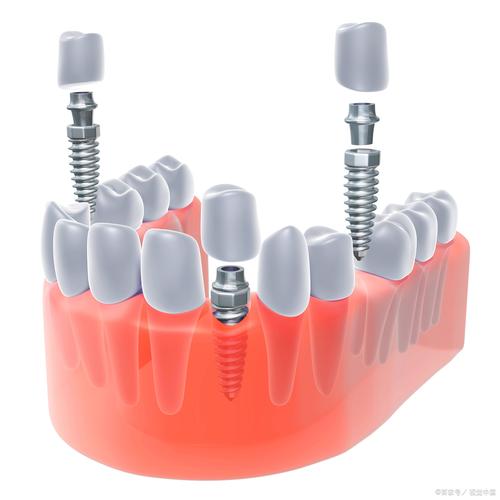 种牙哪种材质好-图2