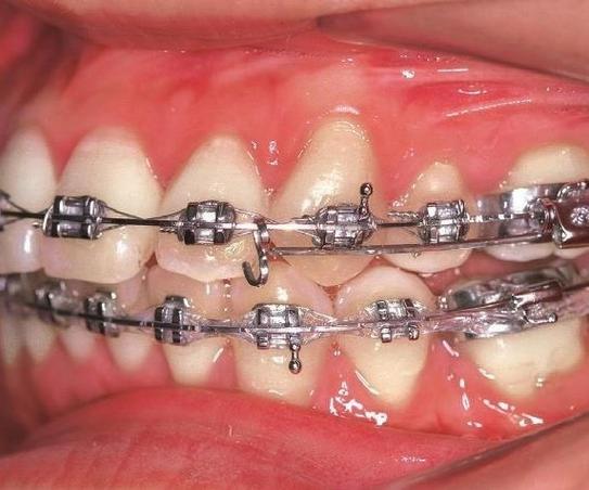 正畸滑动杆弯制图片-图1