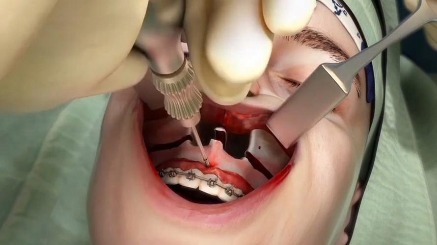 种牙 下唇麻木-图1