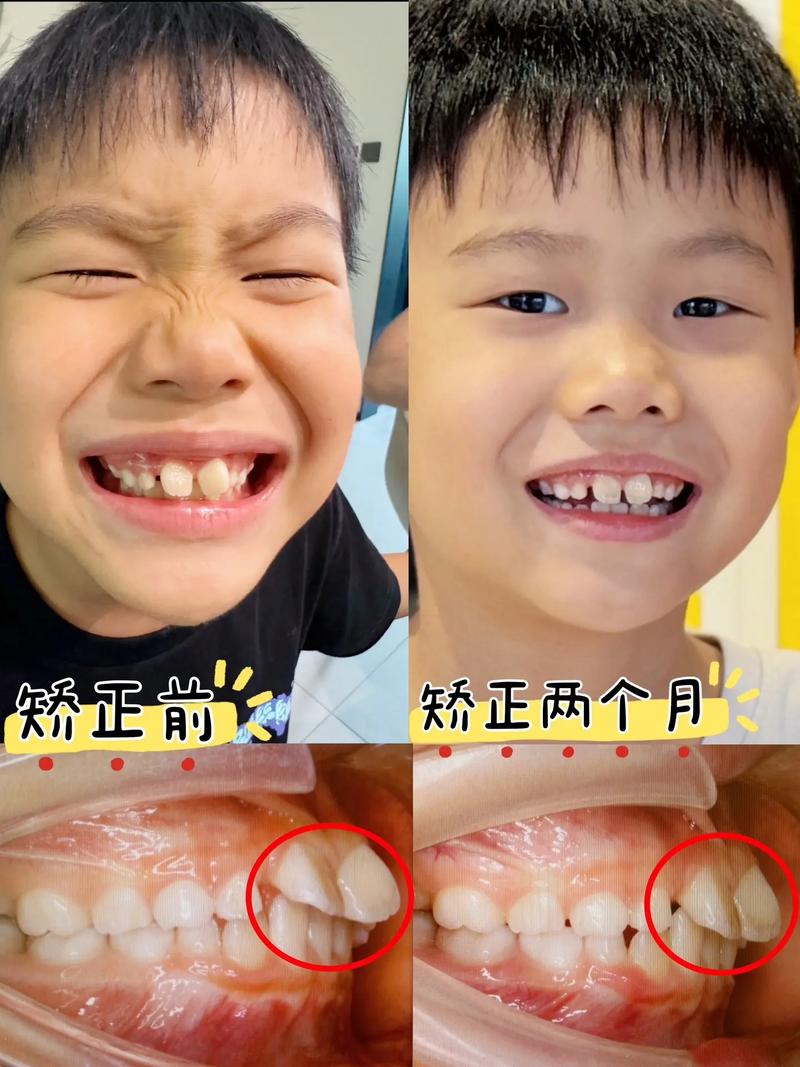 正畸扩弓有什么危害-图3
