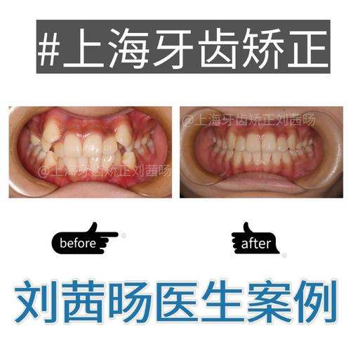 正畸牙每次复诊都痛，是正常现象还是需调整方案？-图3
