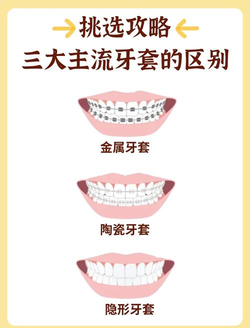 种牙还是带牙套-图2