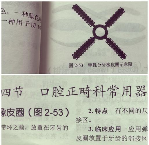 口腔正畸功能调节器-图2