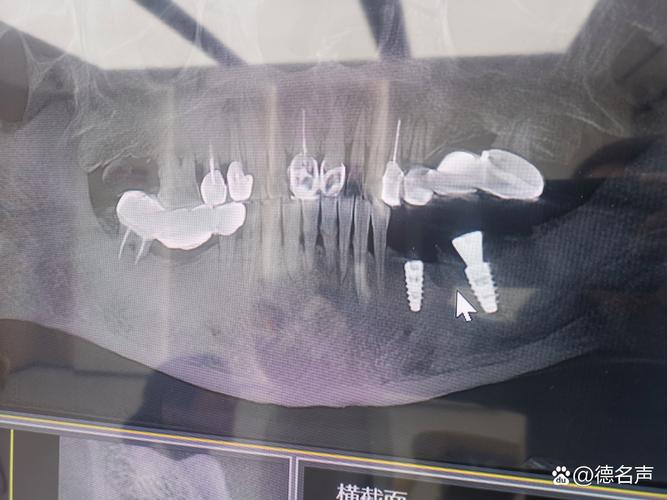 骨密度低 种牙-图3 骨密度低 种牙-图3