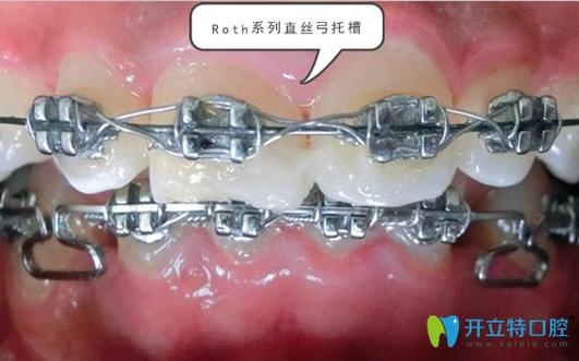 正畸直丝弓托槽是什么？矫正牙齿效果如何？-图3