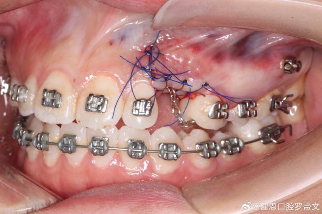 正畸牵引倒置埋伏牙-图3