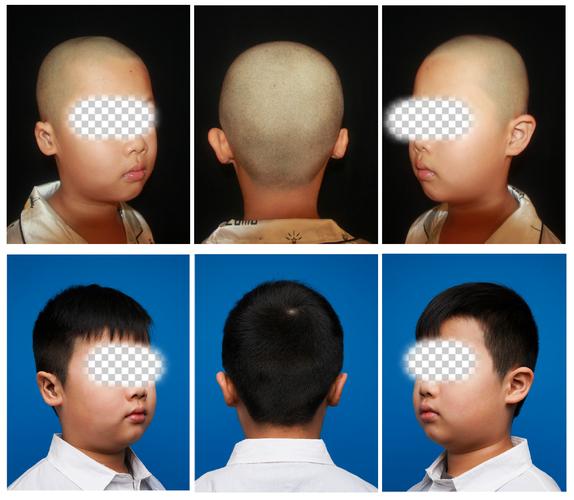 中年人耳朵畸形正畸可行吗？效果如何？-图1