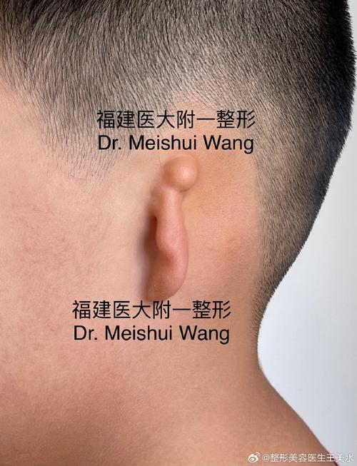 中年人耳朵畸形正畸可行吗？效果如何？-图2