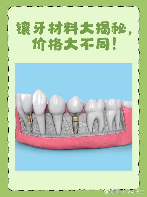 最好种牙材料怎么选?医生揭秘核心标准!-图1 最好种牙材料怎么选?医生揭秘核心标准!-图1