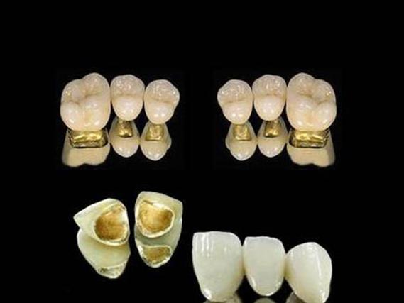种牙牙冠材料怎么选?哪种更耐用又美观划算?-图2 种牙牙冠材料怎么选?哪种更耐用又美观划算?-图2