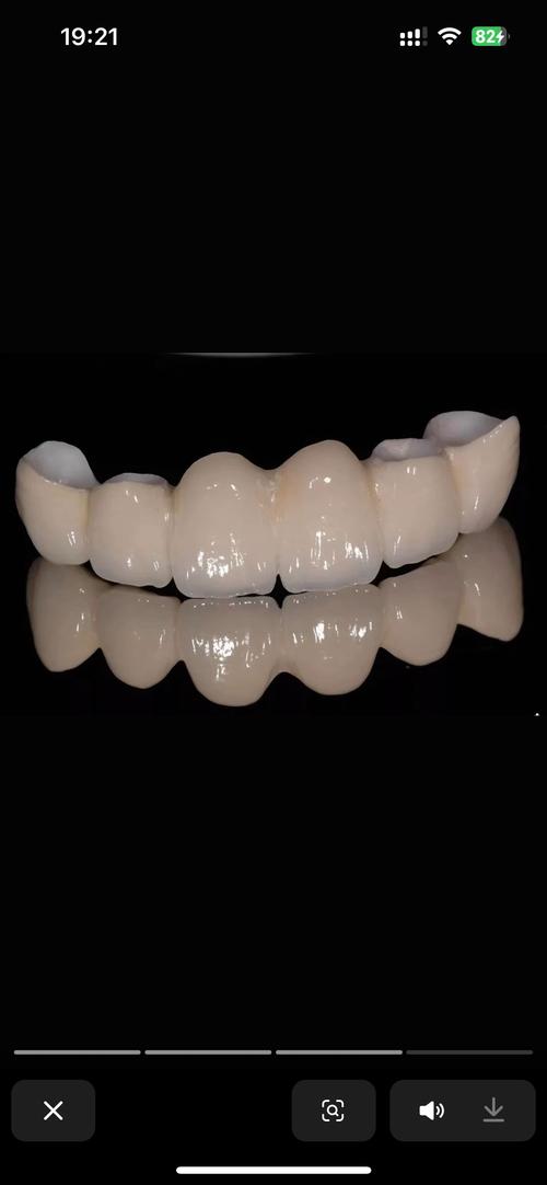 种牙牙冠材料怎么选?哪种更耐用又美观划算?-图3 种牙牙冠材料怎么选?哪种更耐用又美观划算?-图3