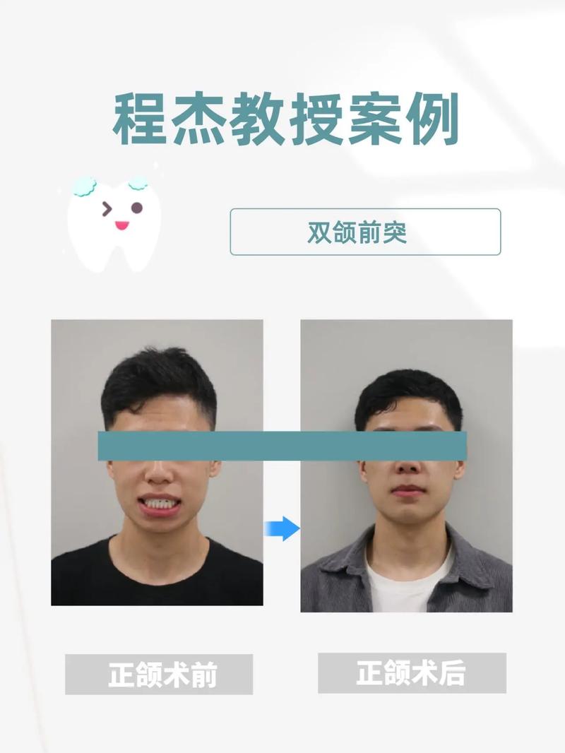 偏颌是正畸还是手术-图1 偏颌是正畸还是手术-图1