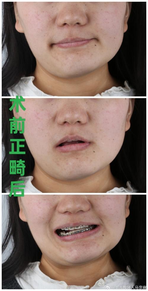 偏颌是正畸还是手术-图2 偏颌是正畸还是手术-图2