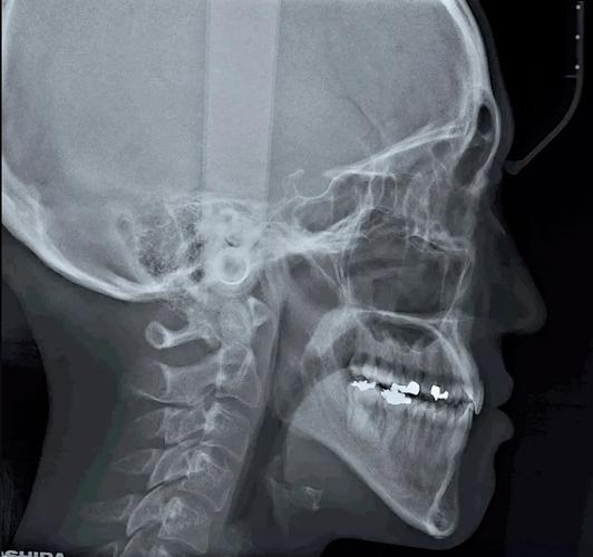 牙齿正畸为何必拍头颅侧位片？它有何关键作用？-图1