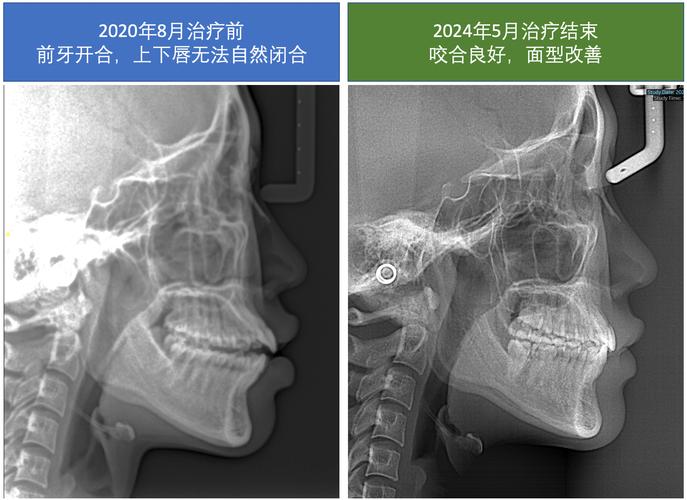 牙齿正畸为何必拍头颅侧位片？它有何关键作用？-图2