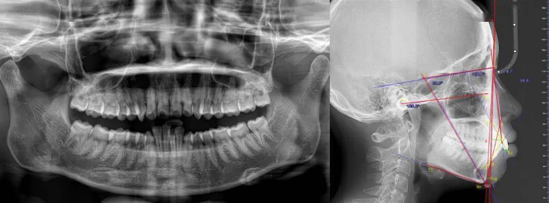 牙齿正畸为何必拍头颅侧位片？它有何关键作用？-图3