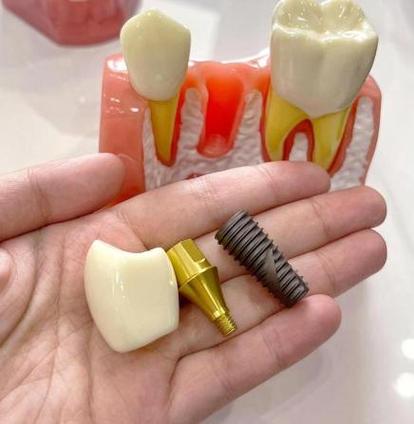 2025种植牙价格会降吗?技术有哪些新突破?-图2 2025种植牙价格会降吗?技术有哪些新突破?-图2