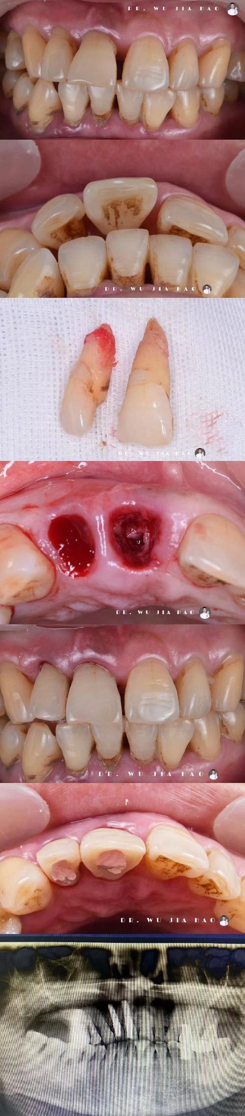 种牙植骨后出血正常吗？需警惕哪些原因及处理方法？-图2