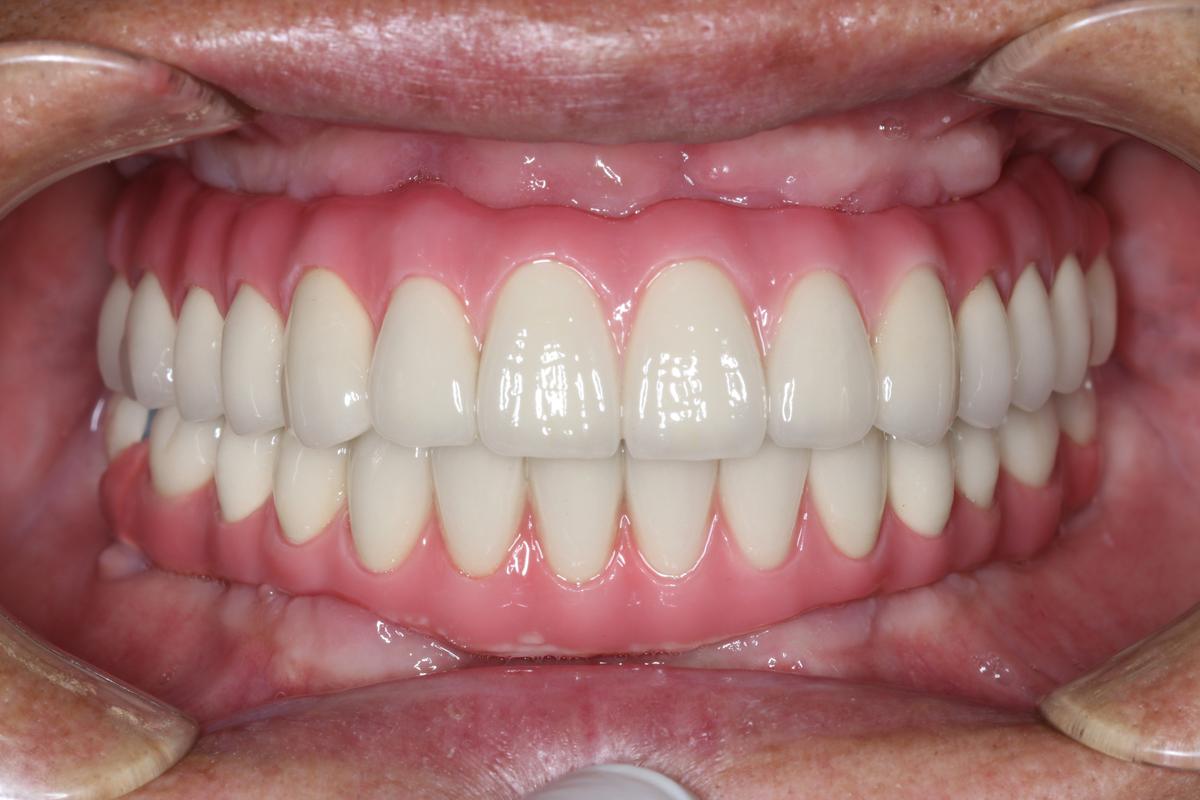 种牙效果怎么样-图1