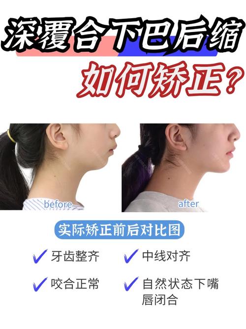 正畸后期咬合变深了-图1