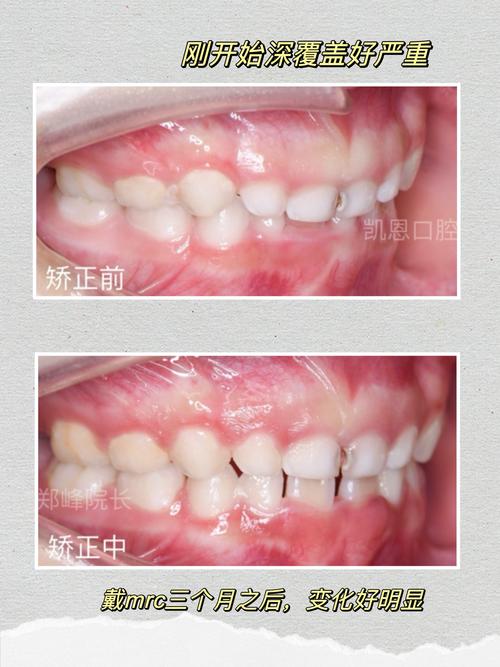 正畸后期咬合变深了-图2