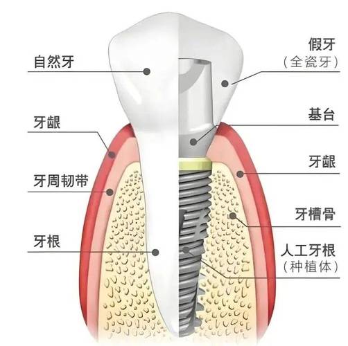 种牙系统有哪些-图2