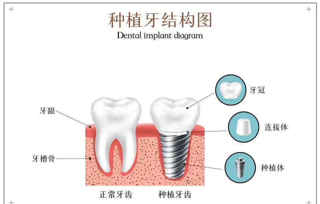 种牙系统有哪些-图3