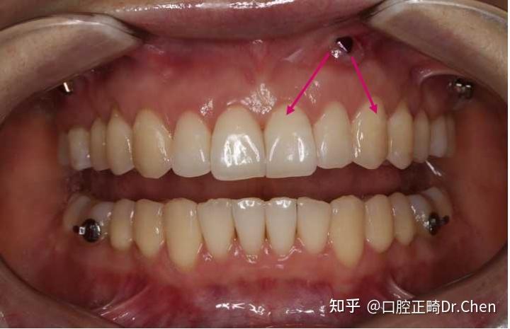 正畸打2个支抗钉？数量有何讲究？-图3