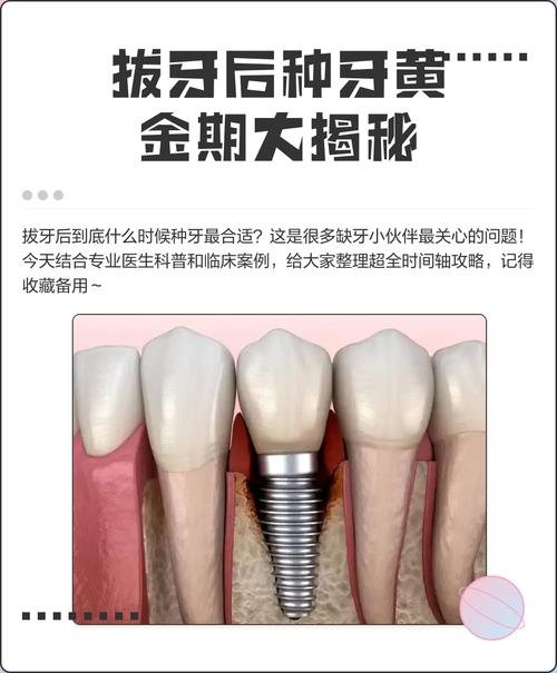 拔牙后立即种牙可行吗?即刻修复效果与风险如何?-图1 拔牙后立即种牙可行吗?即刻修复效果与风险如何?-图1