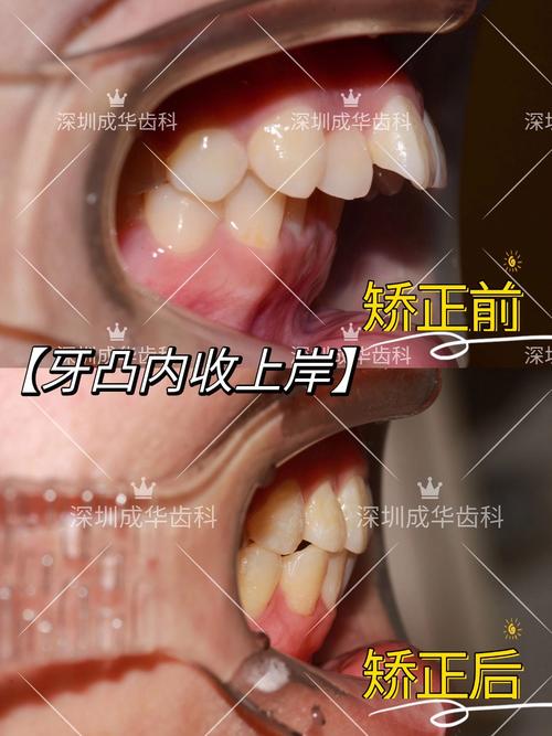 正畸内收一般要多久才能看到效果？-图2