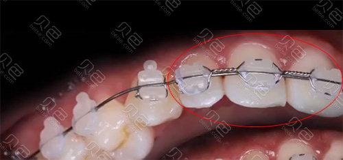 正畸结扎丝弯制视频-图2