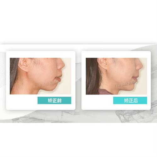 正畸逆时针旋转下巴-图3