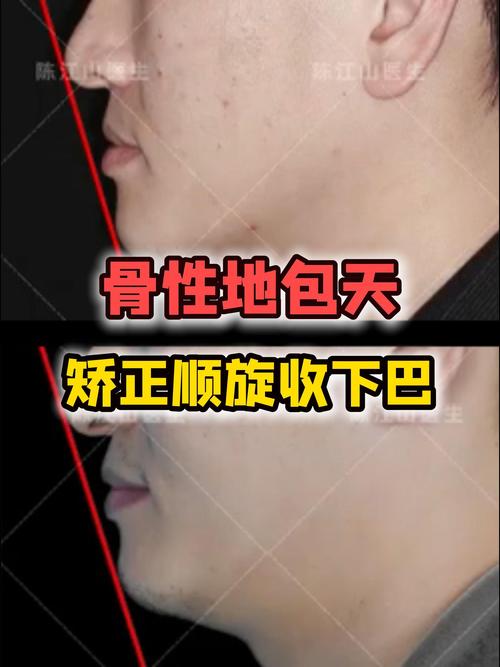 正畸逆时针旋转下巴-图2