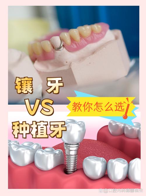 种牙与镶牙区别-图2