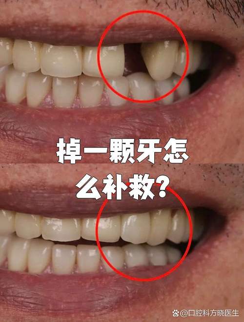 牙掉了能种牙吗-图2