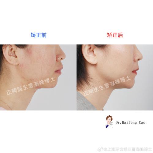 正畸过程中下巴为何脱位？原因、处理及预防建议-图3